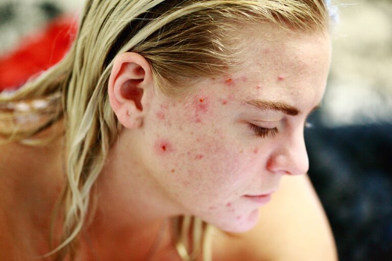 Acné : les solutions pour une peau saine et éclatante
