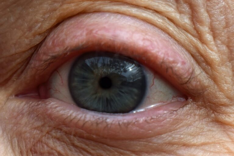 La perte de vision après opération cataracte : tout savoir